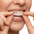 Havenholt Snap-On Veneers for Upper and Lower Teeth