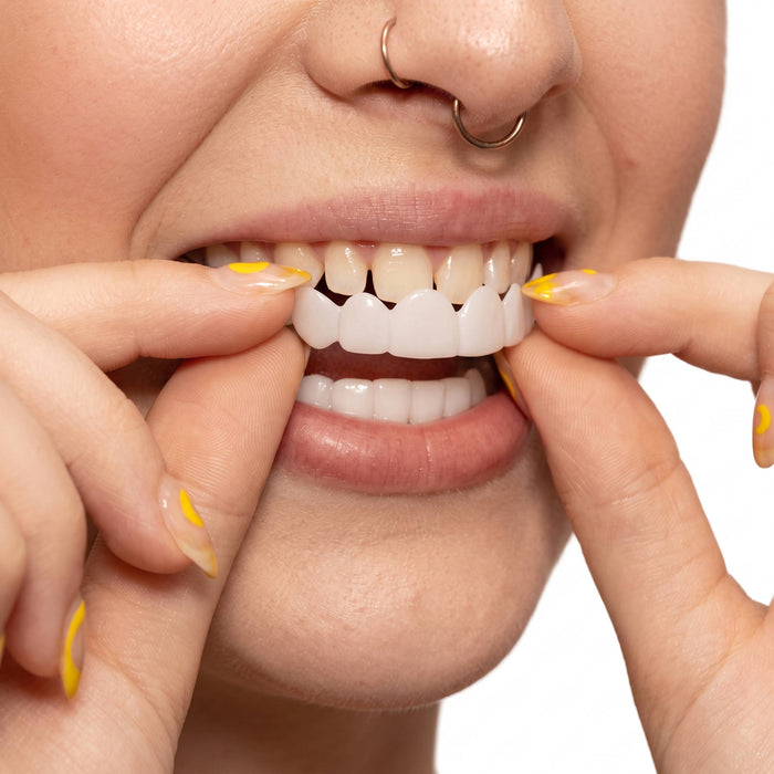 Havenholt Snap-On Veneers for Upper and Lower Teeth