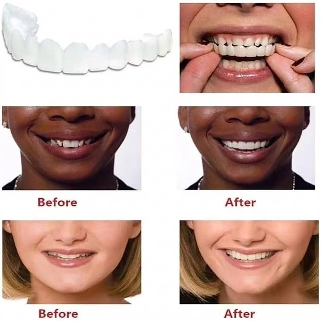 Havenholt Snap-On Veneers for Upper and Lower Teeth