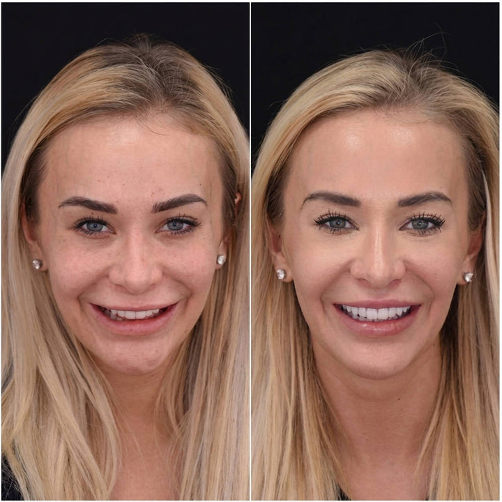 Havenholt Snap-On Veneers for Upper and Lower Teeth