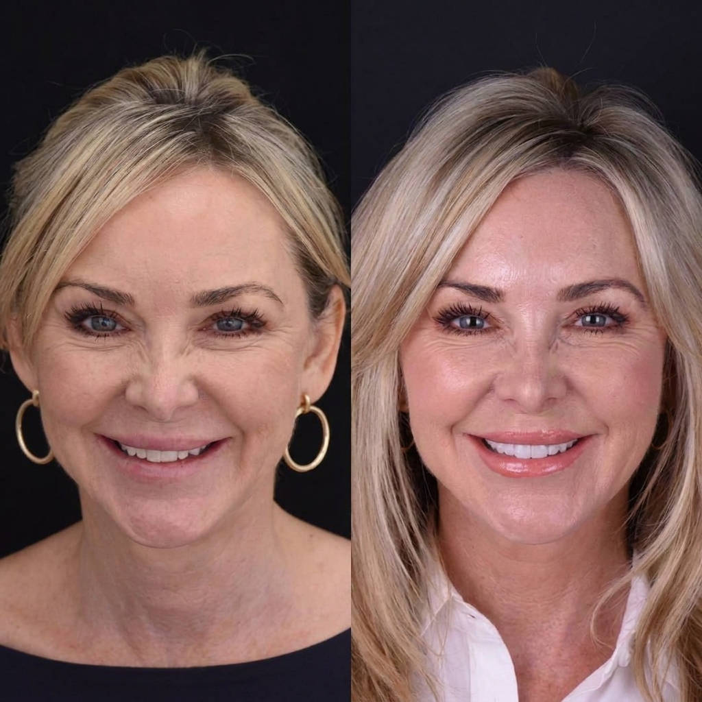 Havenholt Snap-On Veneers for Upper and Lower Teeth