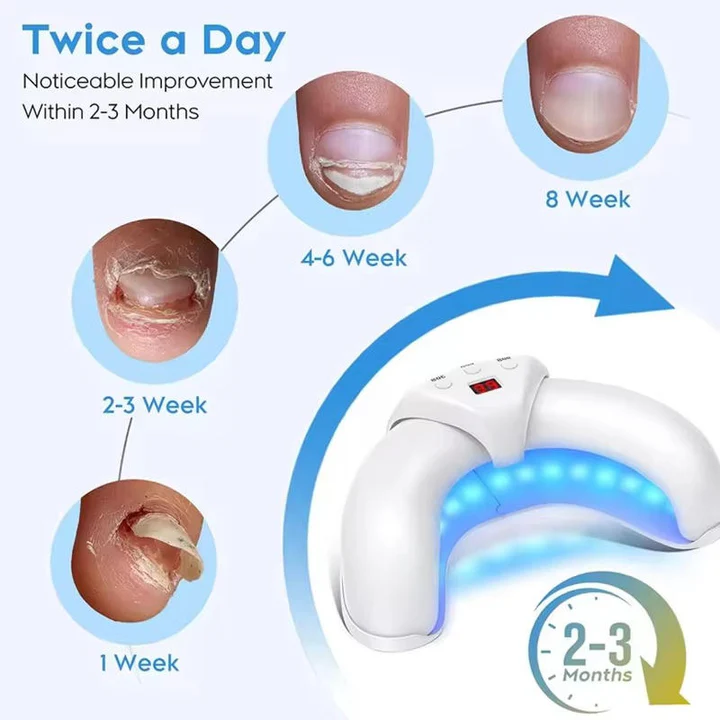 Nail Fungus Laser