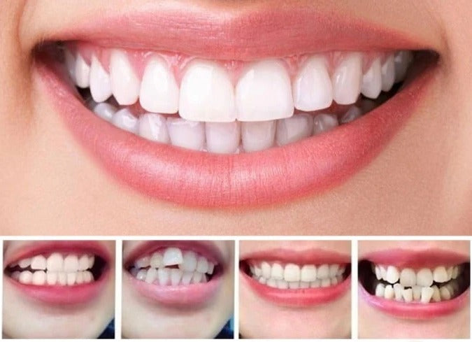 Invisible Dental Realignment Tray