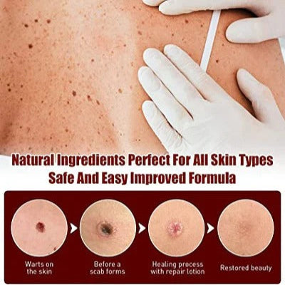 Skin Tag and Mole Appearance Cosmetic Oil